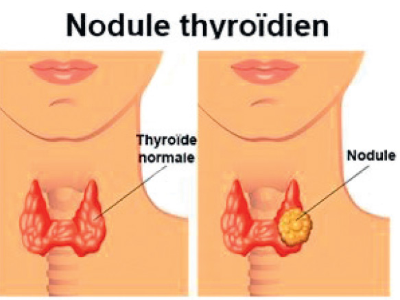 Nodule thyroïdien